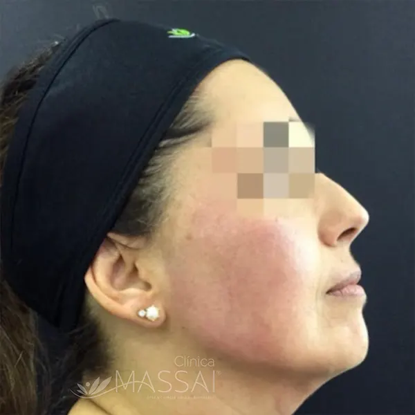 Img-ClinicaMassai-definicion-mandibular-con-acido-hialuronico-medellin