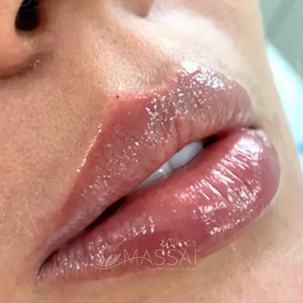 Img-ClinicaMassai-relleno-de-labios-medellin